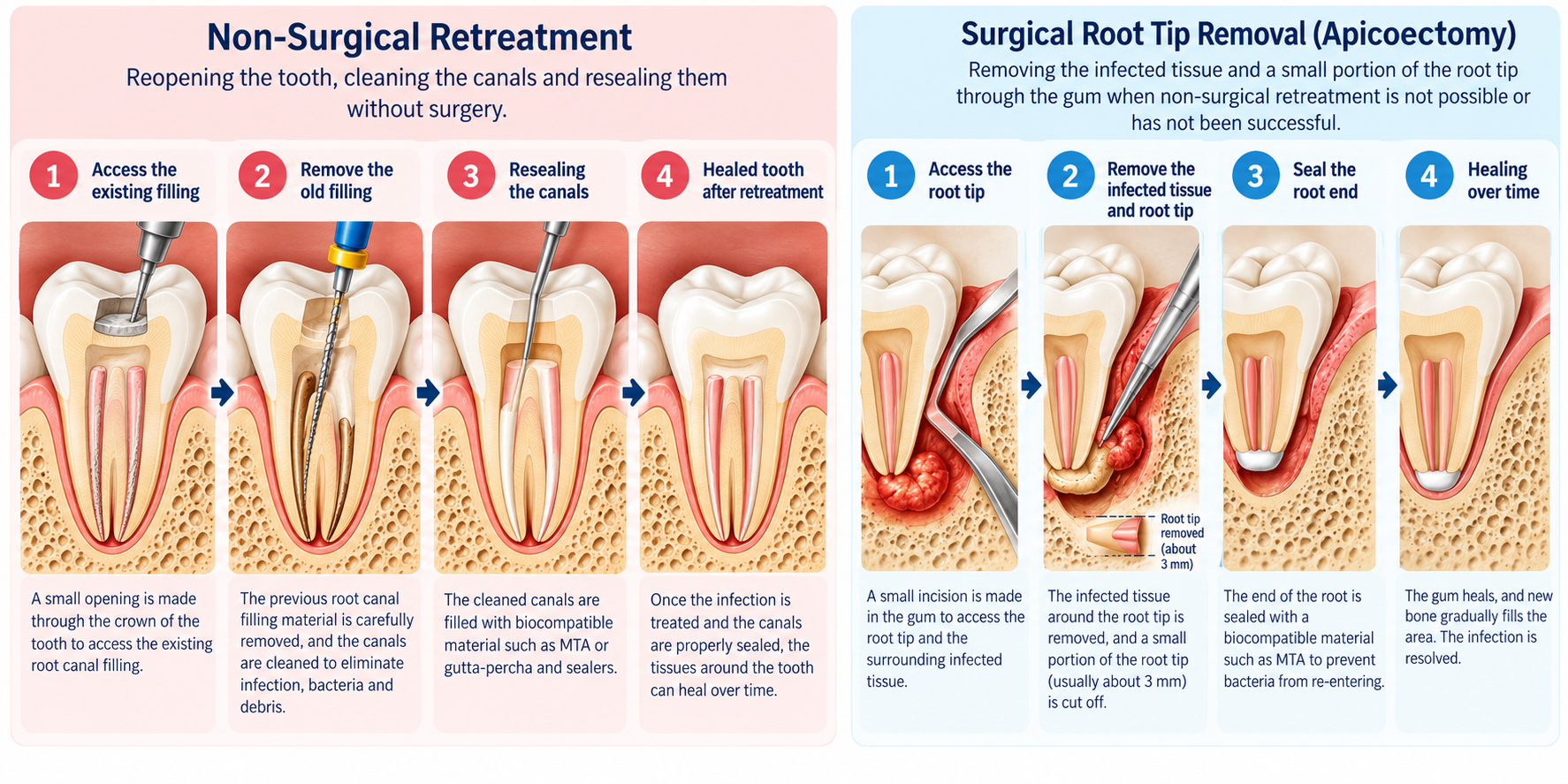 Medical illustration comparing root canal retreatment and apicoectomy, showing the steps involved in cleaning and resealing root canals versus surgically removing and sealing the root tip.