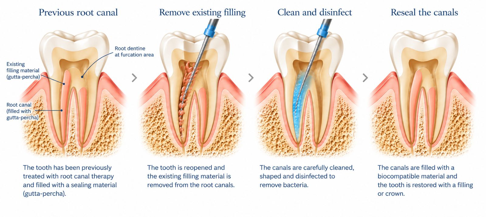 Diagram showing the stages of root canal retreatment.