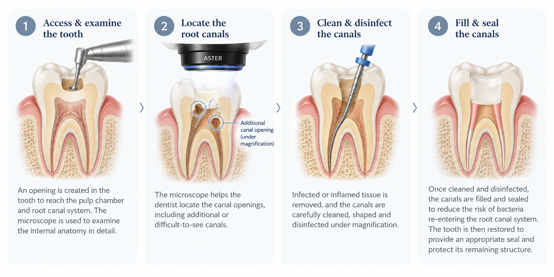 Diagram showing the stages of microscope-assisted root canal treatment.