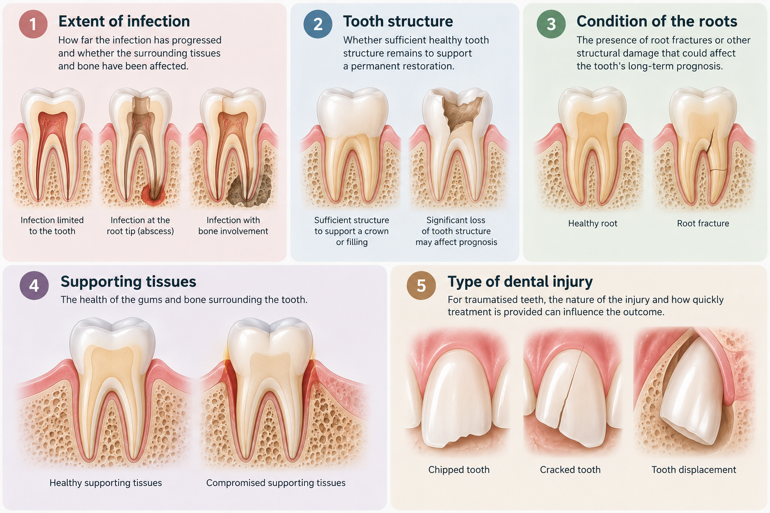 Dental illustration showing five factors affecting endodontic treatment outcomes: infection severity, tooth structure, root fractures, gum and bone health, and dental trauma.