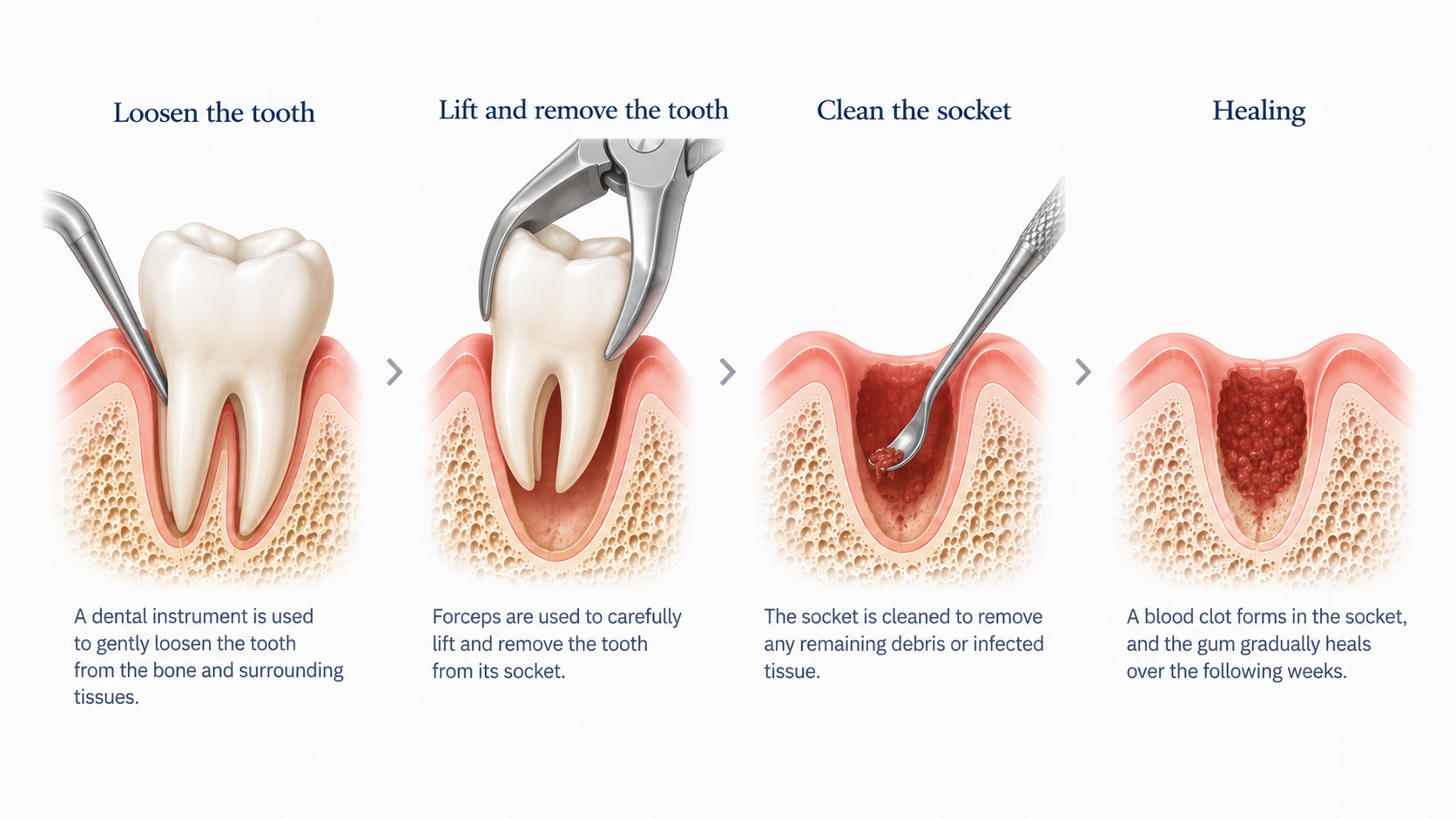 Diagram showing the stages of tooth extraction.