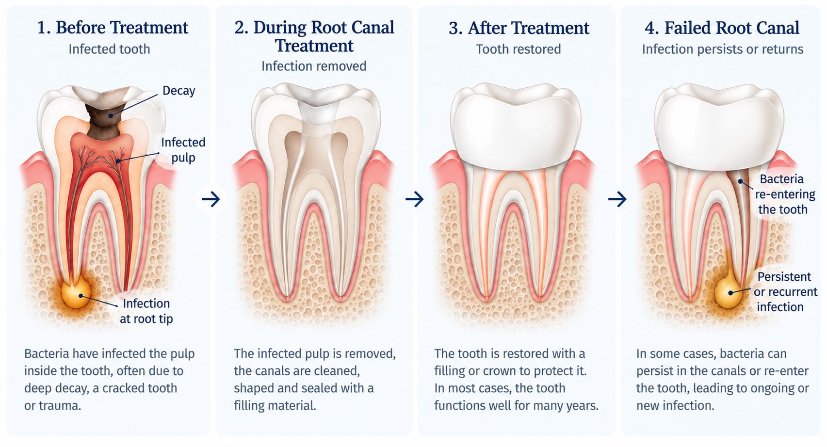 Diagram showing an infected tooth before root canal treatment, the treated and restored tooth, and persistent or recurrent infection after a failed root canal.
