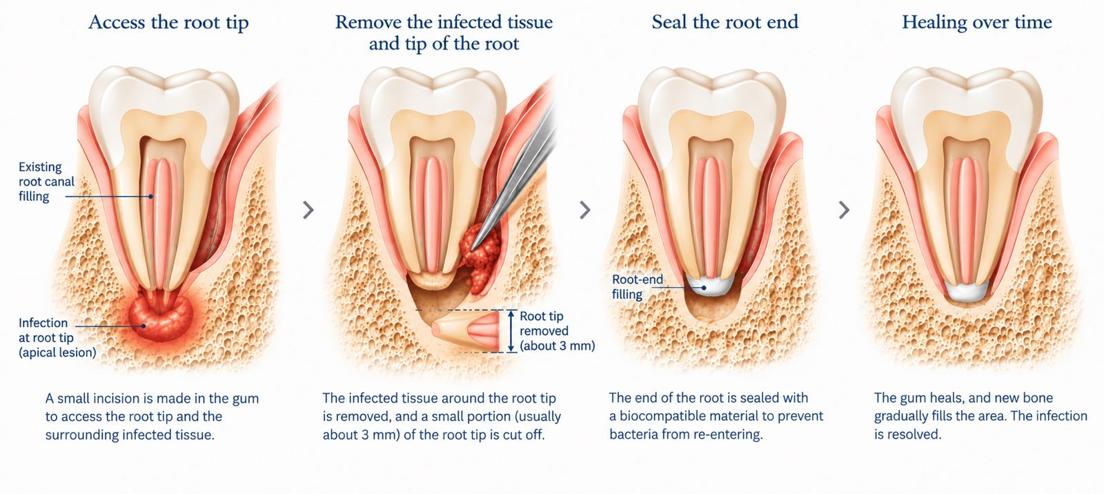 Diagram showing the stages of endodontic surgery (apicoectomy).