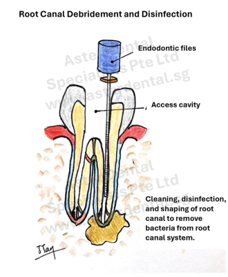 root-canal-debridement-2