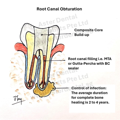 root-canal-obturation-3