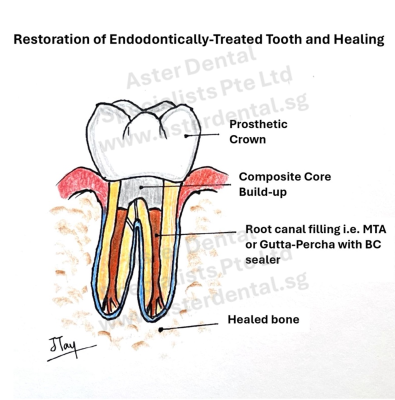 root-canal-restoration-tooth-4