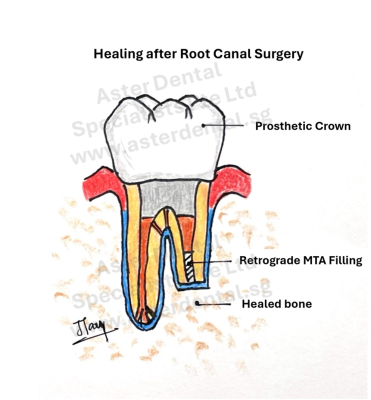 root-canal-surgery-healing