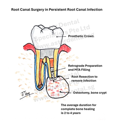 root-canal-surgery